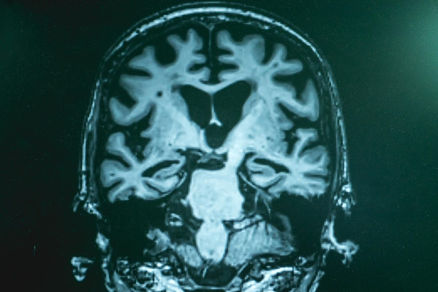 MRI-Brain-Scan-Alzheimers-Dementia-Close-1200x800-i69f927881e1c8.jpg